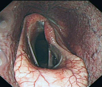 Overground dynamic endoscopy 