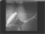 thoracic5