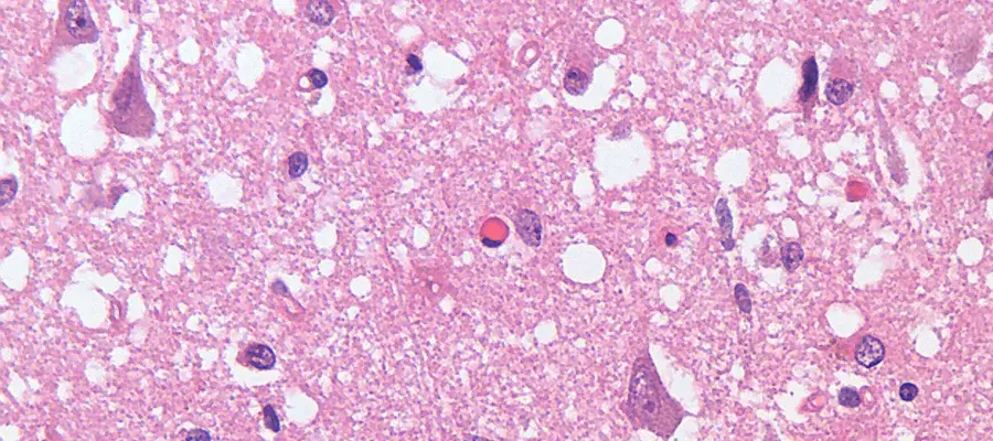 Microscope image of tissue from a human patient who died of variant CJD, a prion disease.