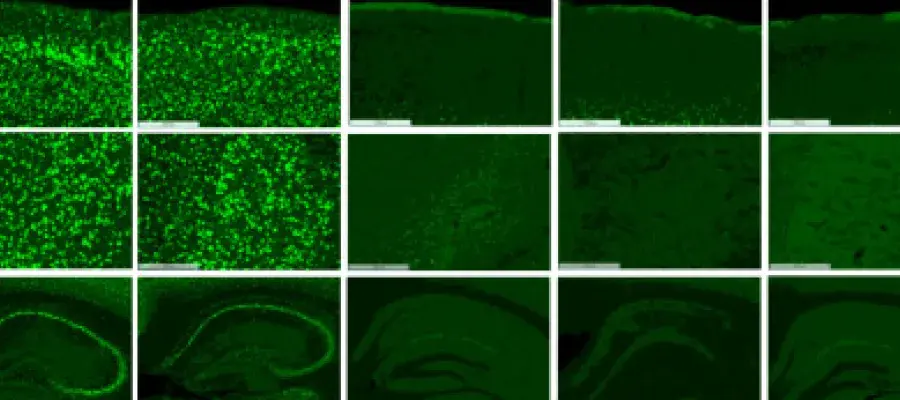Mouse brain scans showing the effects of Batten disease (bright green) compared with healthy control brains, and diseased brains after receiving treatment