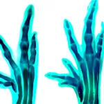 Normal foot and Polydactyly feet