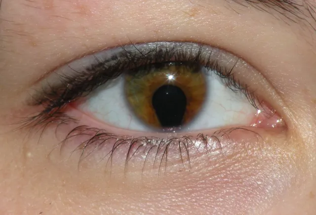 Coloboma of the iris in a 16 year old woman