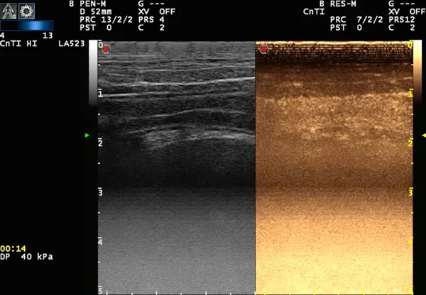 Contrast-enhanced ultrasound of the small intestine.