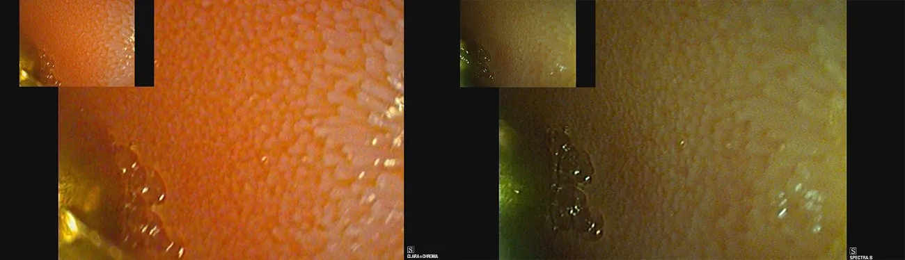 Endoscopic images from the small intestine with the normal \"white light\" settings on the left, and the \"narrow-band imaging\" type setting on the right: