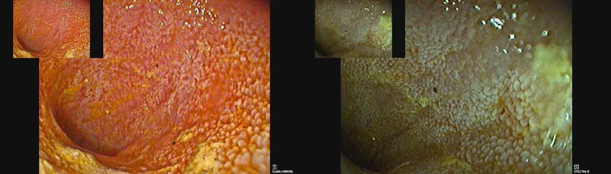 Endoscopical view of the inside of the small intestine: Left panel: normal view where the mucosa appears pink/ orange. Right panel: special \"narrow band imaging\" settings, where the mucosa and vessels appear pale green/ brown.