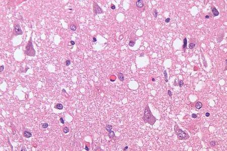 Microscope image of tissue from a human patient who died of variant CJD, a prion disease.
