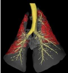 A reconstructed image of sheep lungs affected by OPA tumours, highlighted in red.