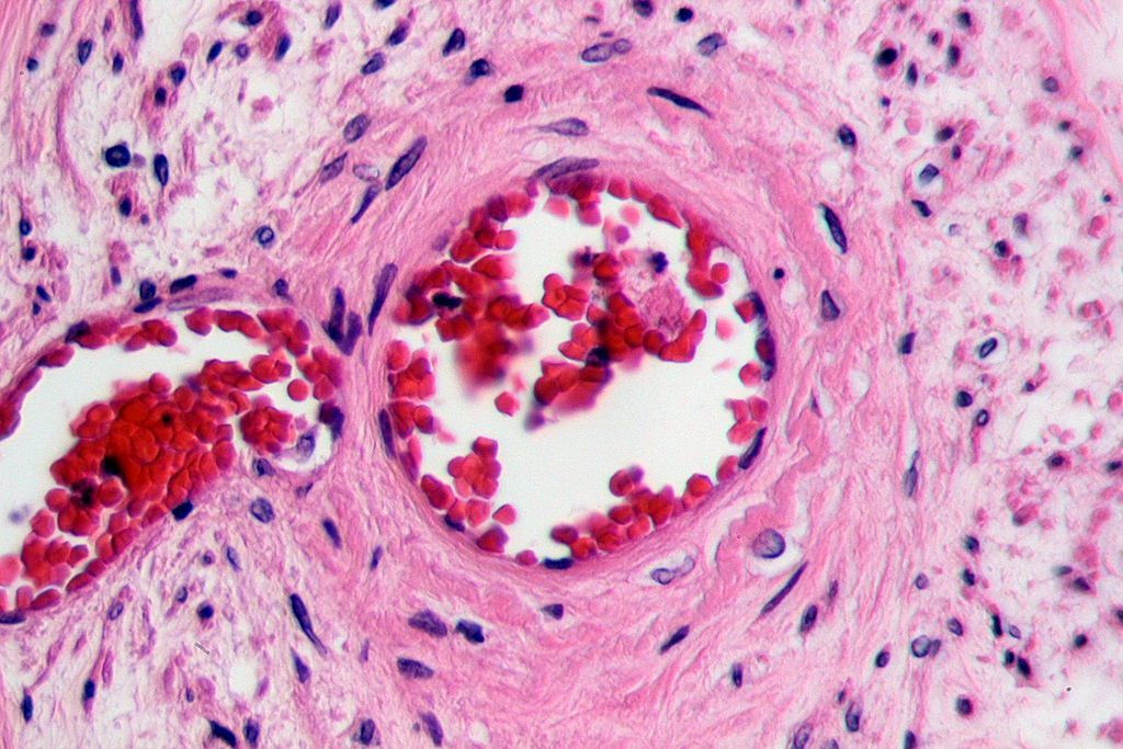 Occluded Artery In Peripheral VascularDisease