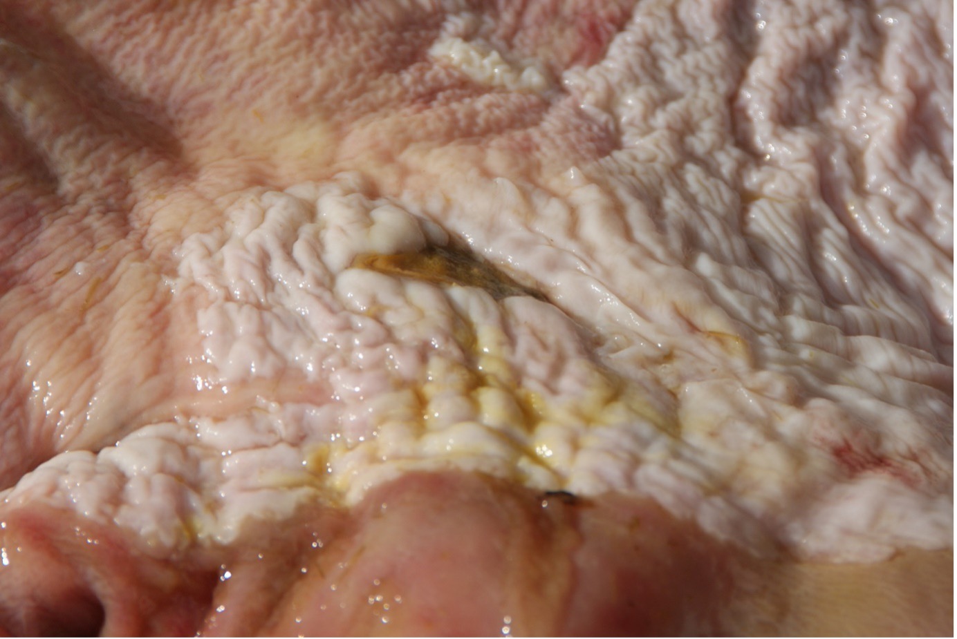 Gastric ulcer