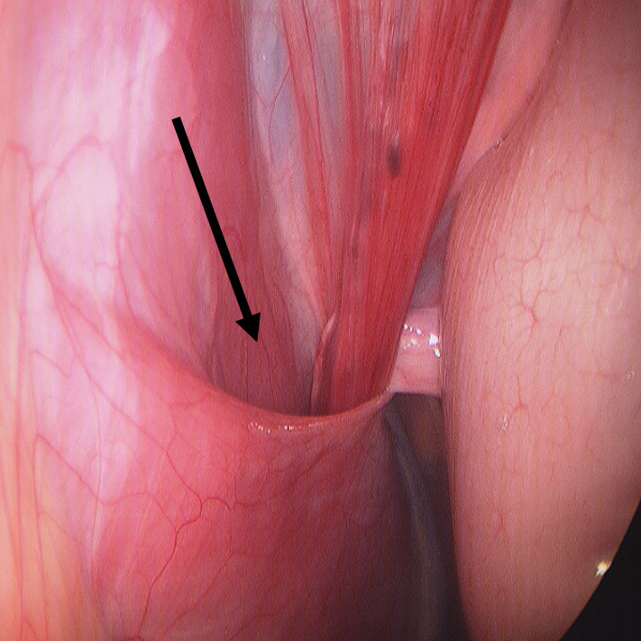 Inguinal ring closure 