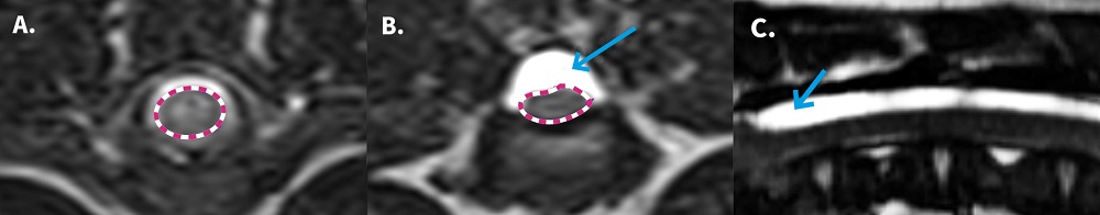 A selection of MRI images. Comparison of [A] normal spinal cord (dotted red circle) and [B] Geralt’s compressed spinal cord (dotted red circle) due to the build-up of cerebrospinal fluid (highlighted by the blue arrow). [C] Geralt’s spinal arachnoid diverticulum (highlighted by blue arrow) running along his spinal cord.